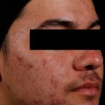 AviClear Before & After Patient #1669